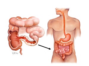 crohns-disease_u