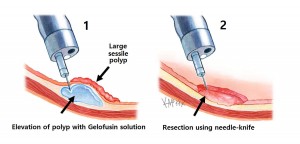 needle-knife-endoscopic-submucosal-dissection_e