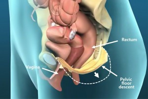 pelvic-floor-descent_e