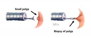 polypectomy_e