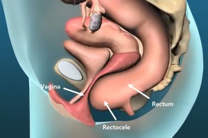 rectocele_e