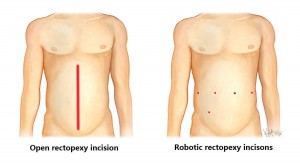 rectopexy-incisions_e