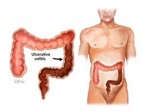 ulcerative-colitis_e